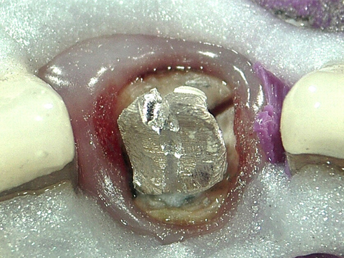 歯の根が割れて