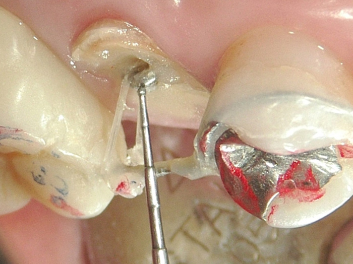 歯根を引き上げ