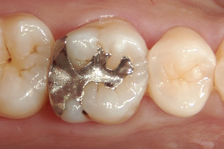 金属アレルギーの原因金属からメタルフリーのセラミックによる審美歯科 ...